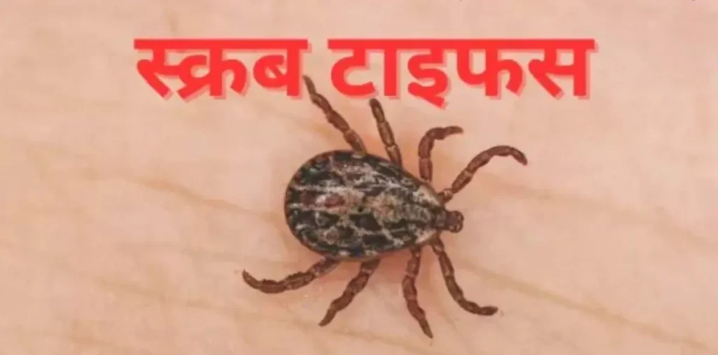 छत्तीसगढ़ के जांजगीर में स्वाइन फ्लू के बाद स्क्रब टाइफस का कहर: तुसमा के युवक ने बिलासपुर में तोड़ा दम, 5 मरीज भर्ती – राष्ट्रवाणी छत्तीसगढ़ के जांजगीर में स्वाइन फ्लू के बाद स्क्रब टाइफस का कहर: तुसमा के युवक ने बिलासपुर में तोड़ा दम, 5 मरीज भर्ती – राष्ट्रवाणी