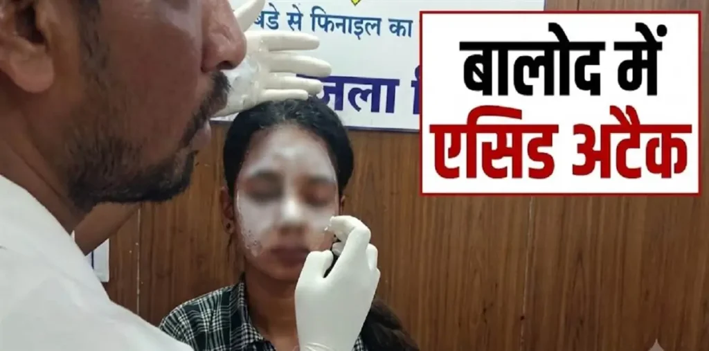 बालोद में लाइब्रेरी से लौट रही युवती पर एसिड अटैक, सिंचाई कॉलोनी की घटना, हमलावर का सुराग नहीं – राष्ट्रवाणी